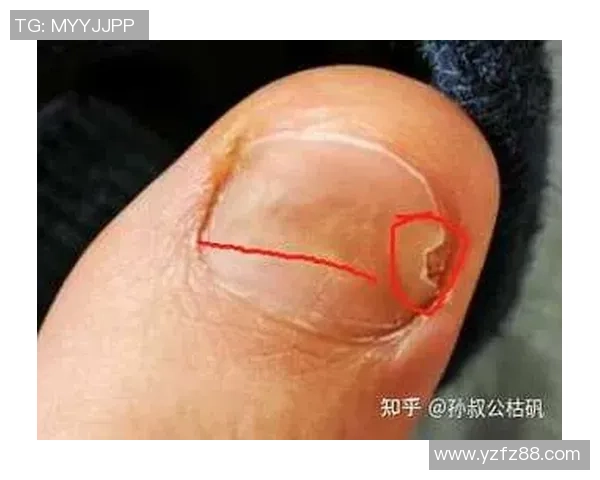 足球灰指甲的成因与预防措施解析助你远离脚部健康隐患 足球灰指甲的成因与预防措施解析助你远离脚部健康隐患